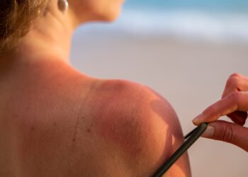 La peligrosa moda del “callo solar” (FreePick).