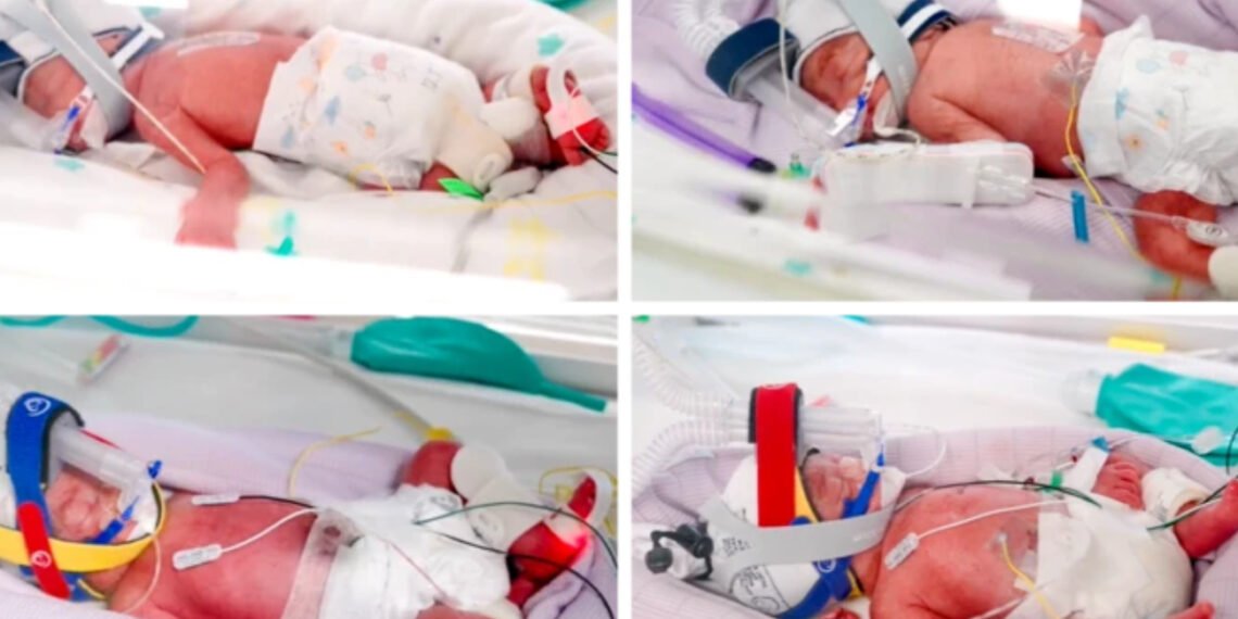 El asombroso caso de las cuatrillizas idénticas: un milagro de 1 en 15 millones en Australia (Metro North Health).
